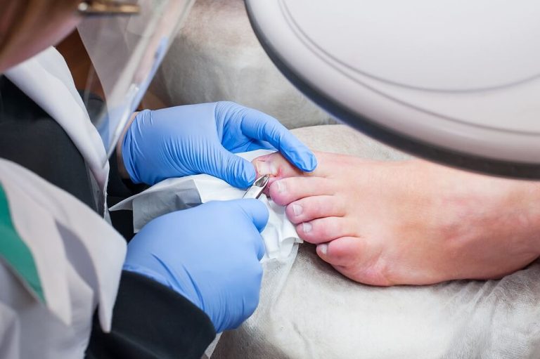 Ingrown Toenail Treatment Canberra